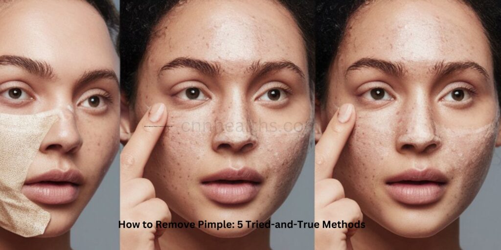 How to Remove Pimple: 5 Tried-and-True Methods
